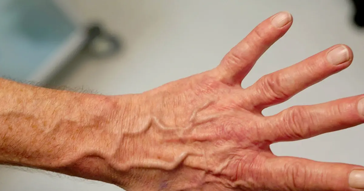 Suddenly Seeing More Veins on Your Skin? Here Are Some Possible Reasons