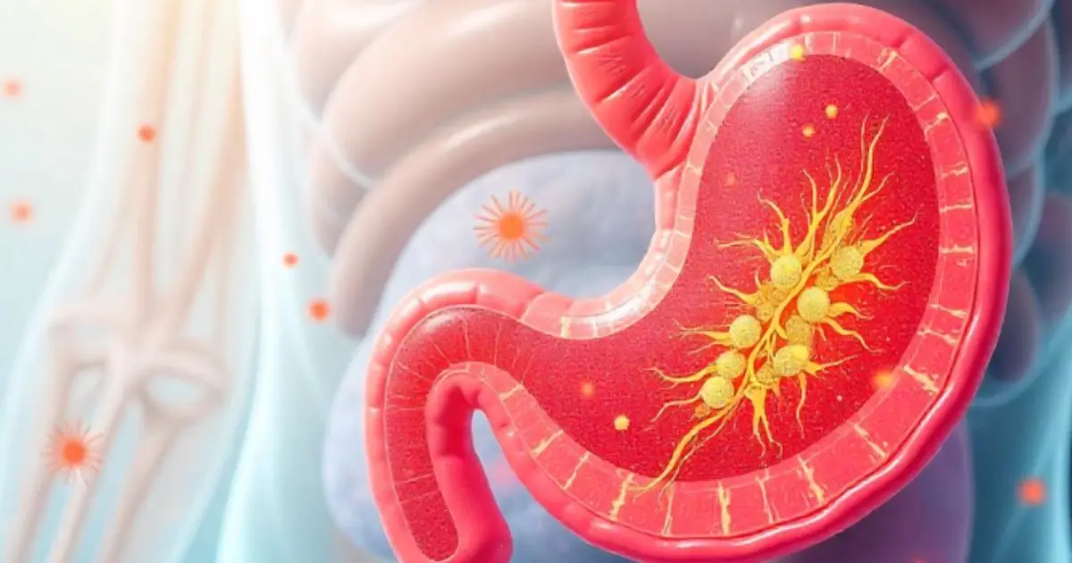 Think Your Stomach Is Fine? H. pylori Can Sometimes Hide Without Clear Symptoms…