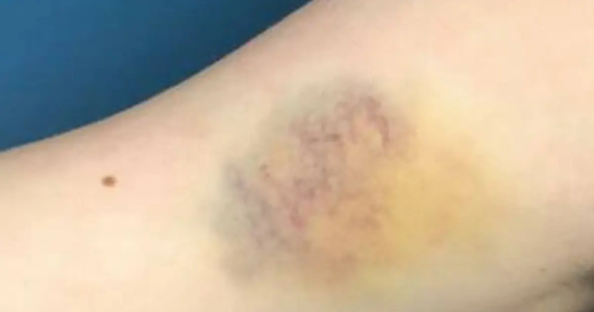 Not Every Bruise Is Just a Bruise—Here’s When It Could Be Worth Checking