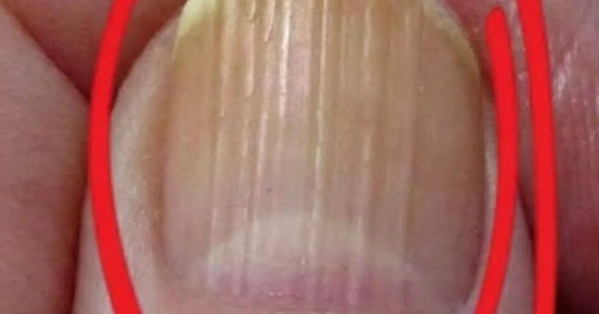 If You Have Lines on Your Nails, It Means You Have Ca…