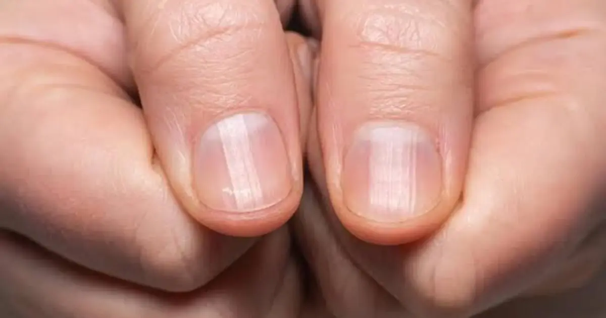 Have You Noticed Lines on Your Nails? Here’s What to Know