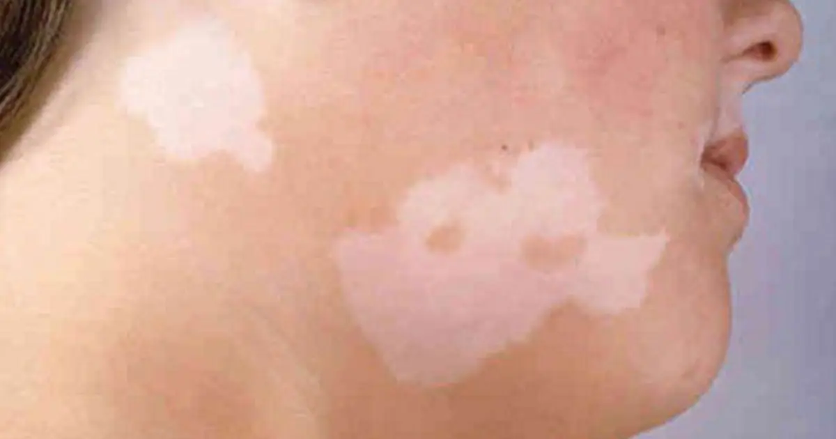 Have You Noticed Small White Spots on Your Skin? Here’s What They May Mean