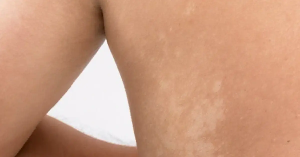 Those Tiny White Spots on Your Skin May Be Trying to Tell You Something