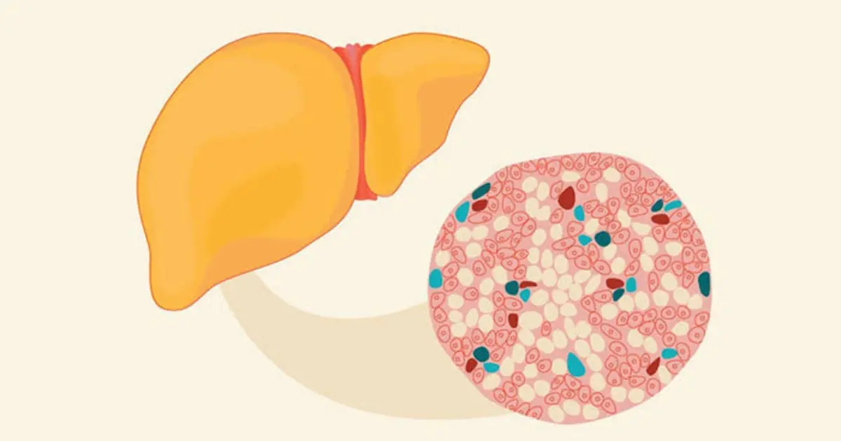 Is Your Liver Showing Warning Signs? 8 Possible Symptoms of Fatty Liver
