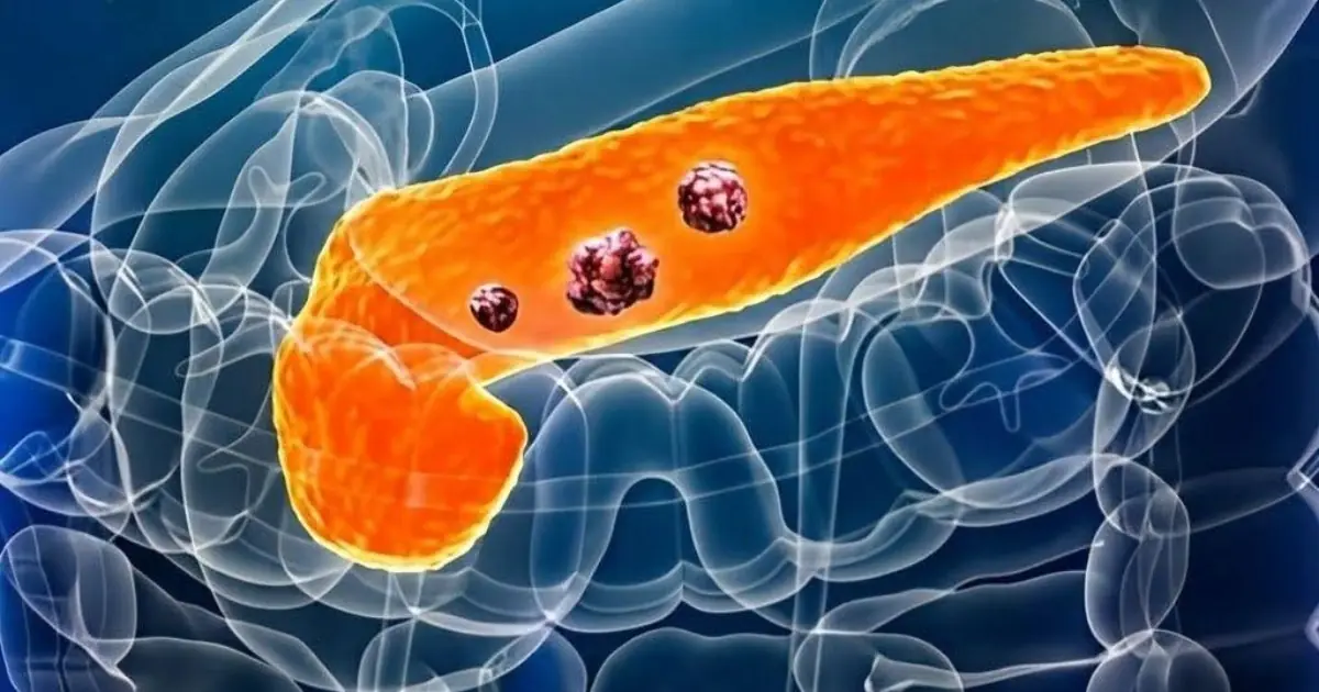 Pancreatic Can.cer: Early Warning Signs and Symptoms You Should Know...
