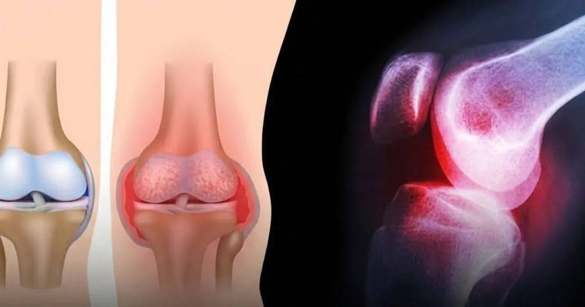 6 Foods That May Affect Calcium Balance and Bone Health if Consumed in Excess...