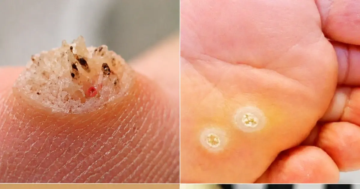 6 Types of Warts: Signs, Symptoms, Home Remedies, and Treatment Options