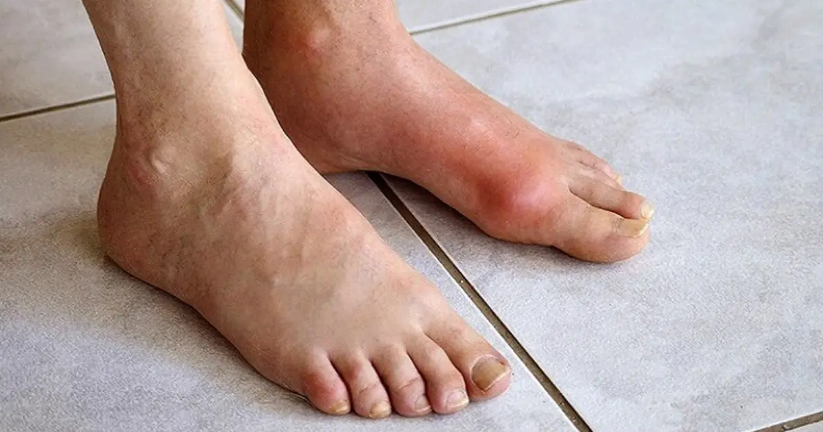 Leg Swelling and Fluid Retention: Conditions You Shouldn’t Ignore