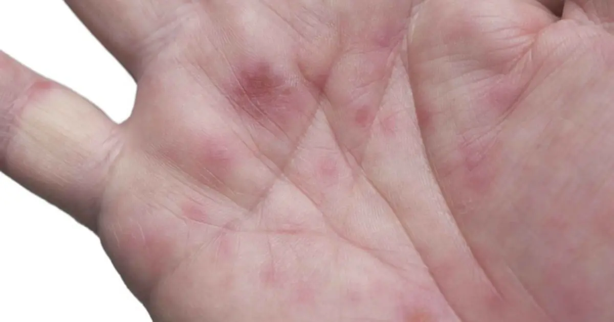 Fatty Liver: 7 Possible Signs You May Notice on Your Skin