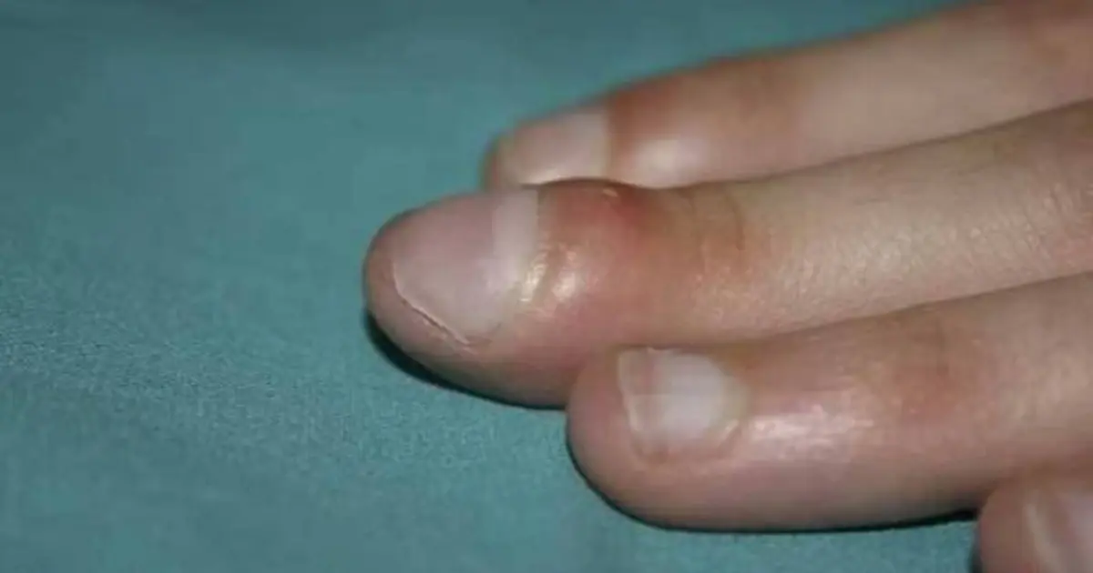 Notice This Change in Your Fingers? It May Be Linked to Lung Disease