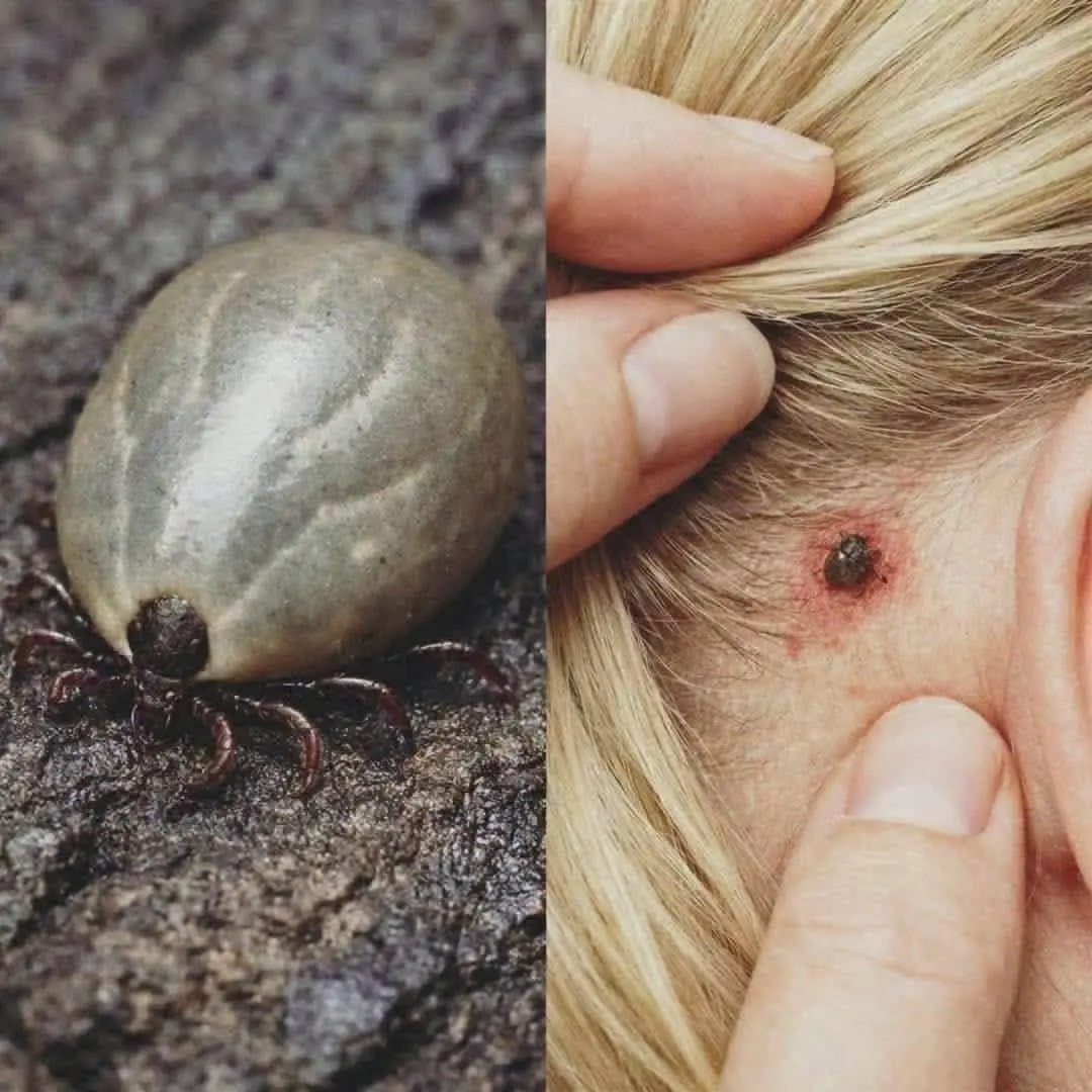 Found a Tick on Your Child? What Every Parent Should Know