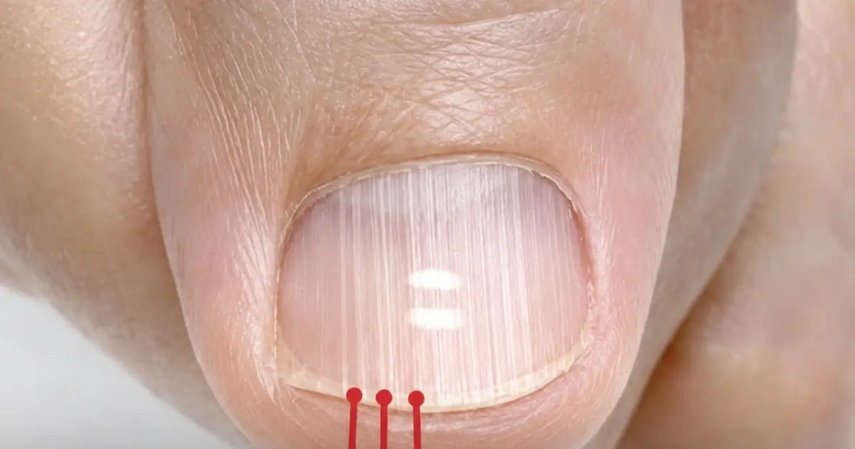 If you have these lines on your nails after 40, it is a clear sign that..