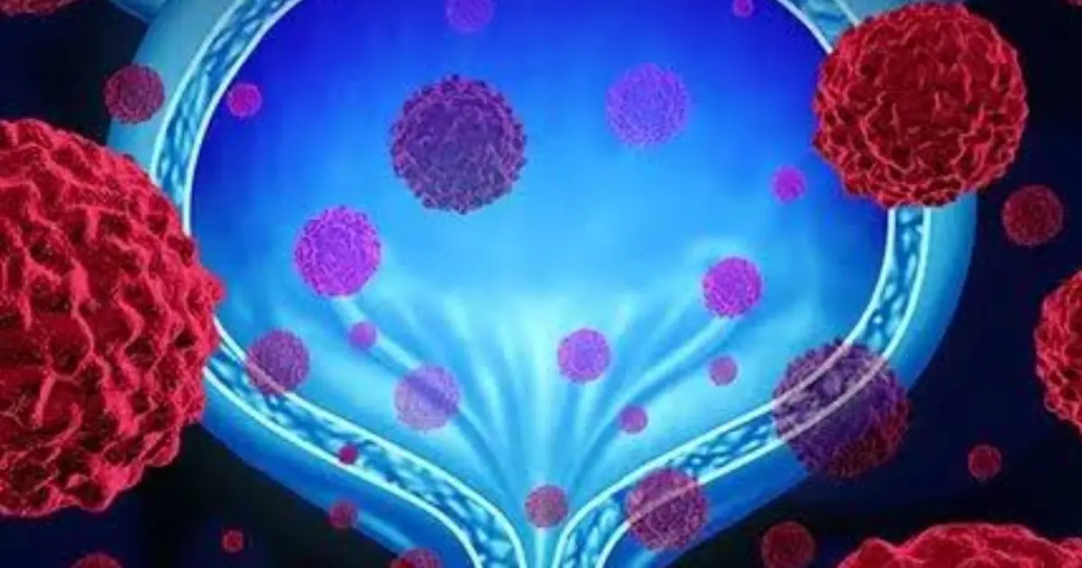 Don’t Ignore These Possible Bladder Cancer Warning Signs Your Body May Show Early