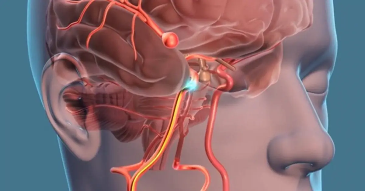 A Brain Aneurysm Can Rupture Suddenly - 7 Warning Signs to Watch For