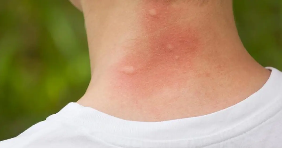 ATTENTION to These First Signs of Infection: Why Doctors Warn That Even a Small Cut or Insect Bite Needs Care