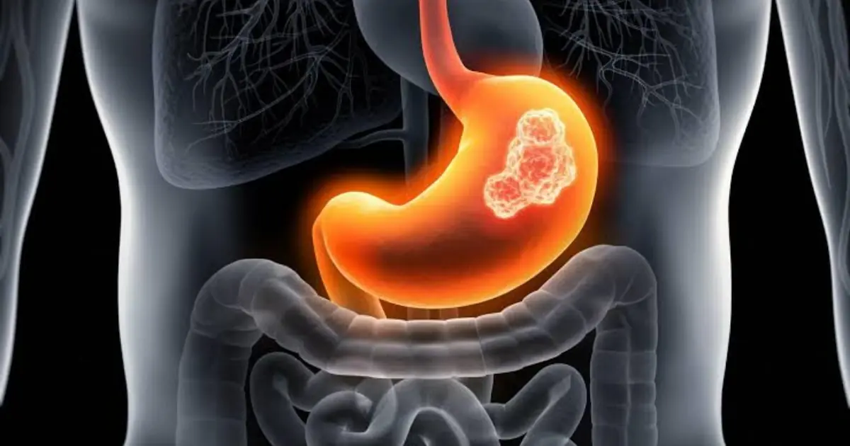 Advanced Stomach Can.cer: 7 Symptoms Worth Paying Attention To