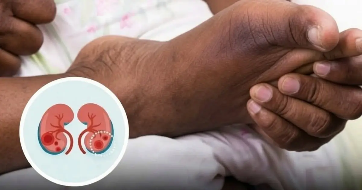 Your Feet Could Reveal Important Health Clues: 5 Signs That May Be Linked to Kidney Problems...