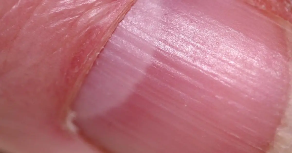 Observe Your Nails: 3 Warning Signs That Could Reveal Hidden Health Problems