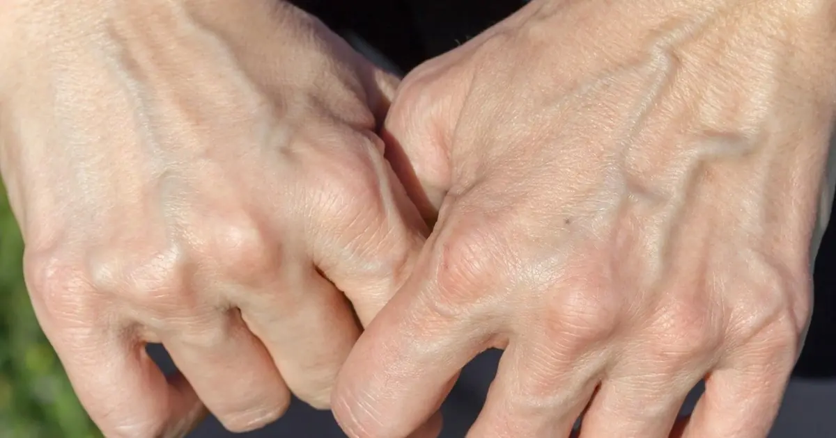 Why Are My Veins Suddenly Bulging and Visible?