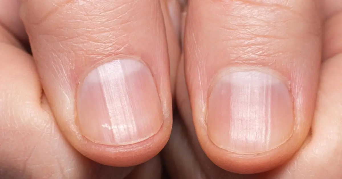 Having Striped Nails Could Mean That Your Body Is Trying to Tell You Something