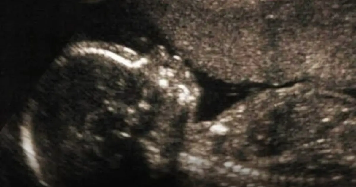New Study Explores Possible Links Between the Immune System and Autism