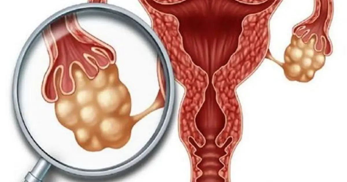 Possible Symptoms of Ovarian Can.cer You Need to Recognize