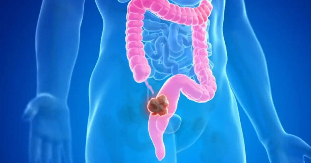 Planning an Overnight Colon Cleanse? Here’s What Experts Want You to Know