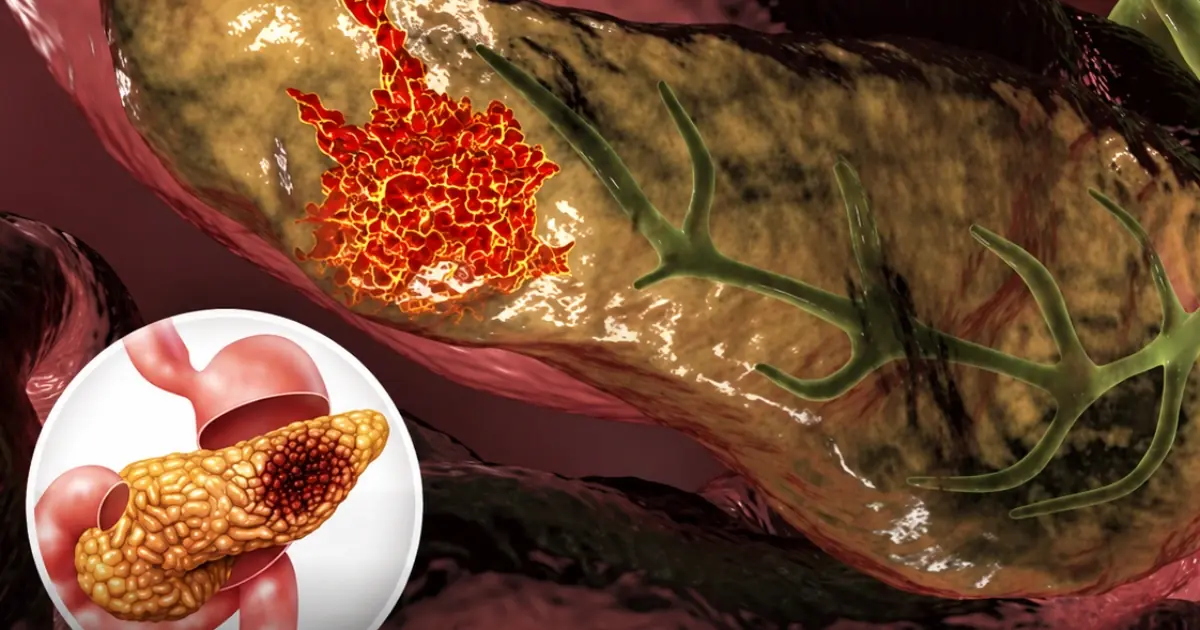 10 Early Signs of Pancreatic Can.cer You Should Never Ignore