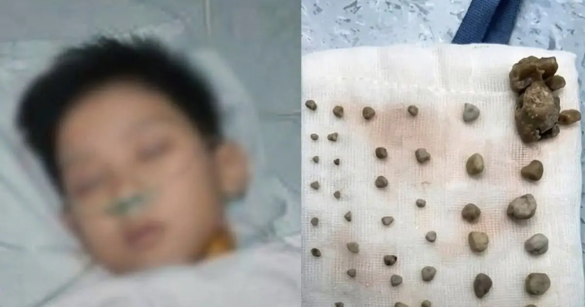 9-Year-Old Boy Found With 56 Stones in His Abdomen — Doctor Reveals the Cause, Mother Breaks Down After Learning It Was Something She Gave Him Every Day