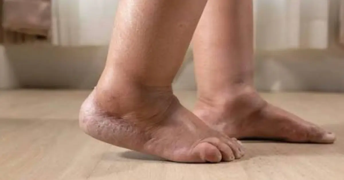 Swelling in Your Legs Could Be More Than Just Tiredness — Here’s What to Know