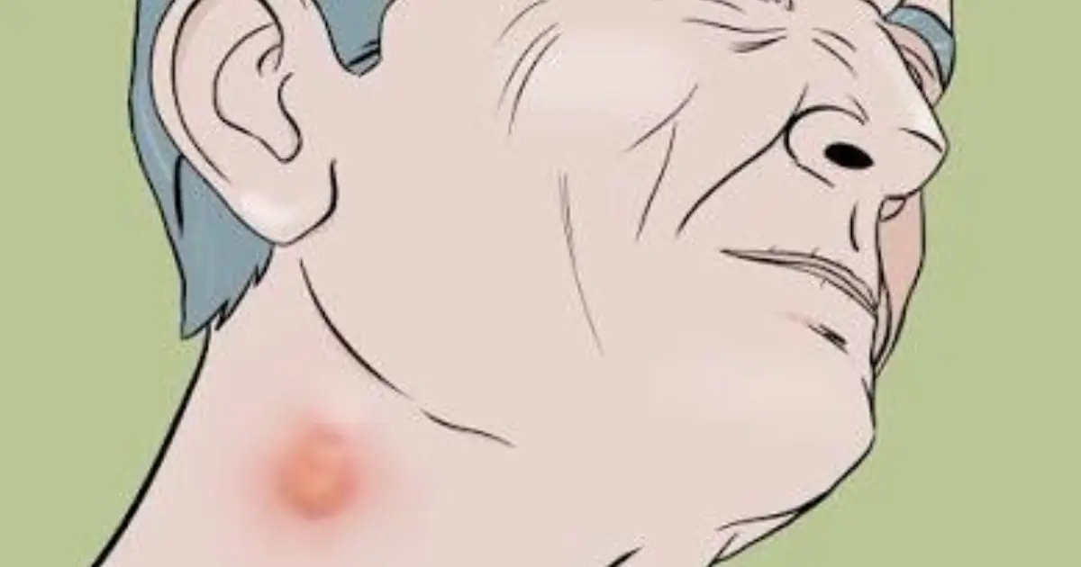Before You Ignore That Lump on Your Neck, Read What Doctors Have to Say…