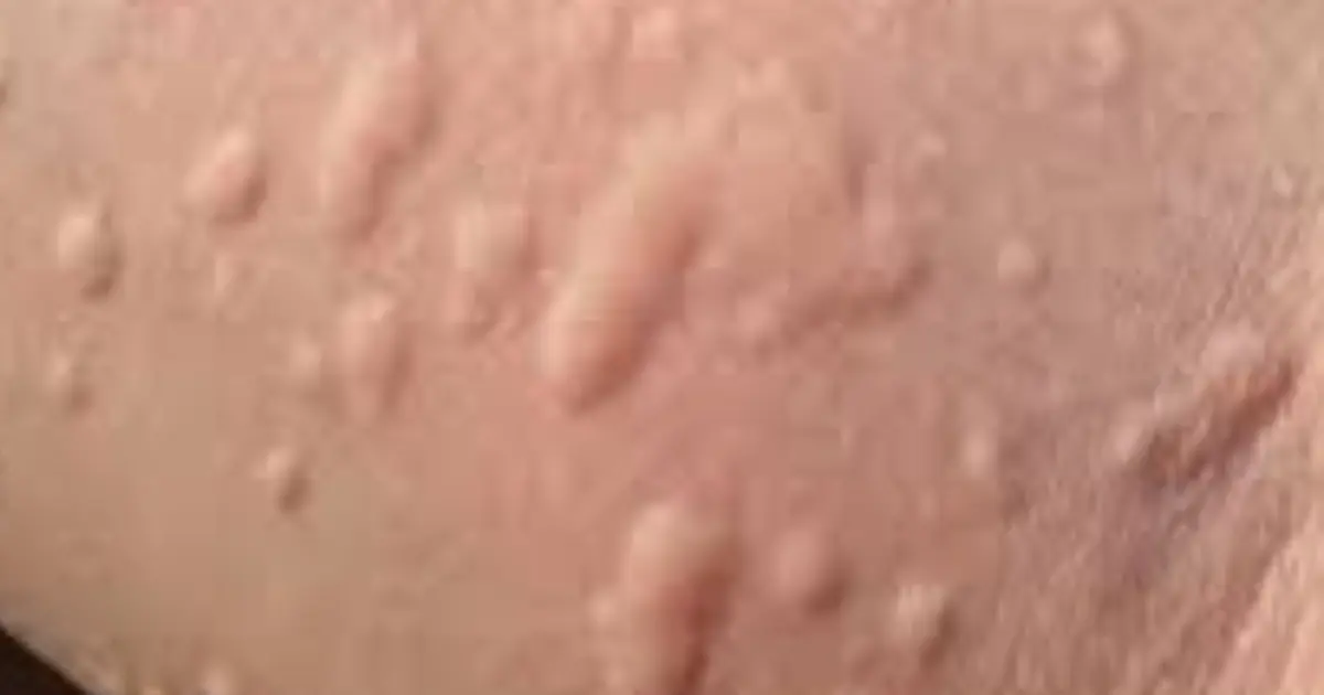 Waking Up With Itchy Bumps? Here Are Some Possible Reasons You Should Know