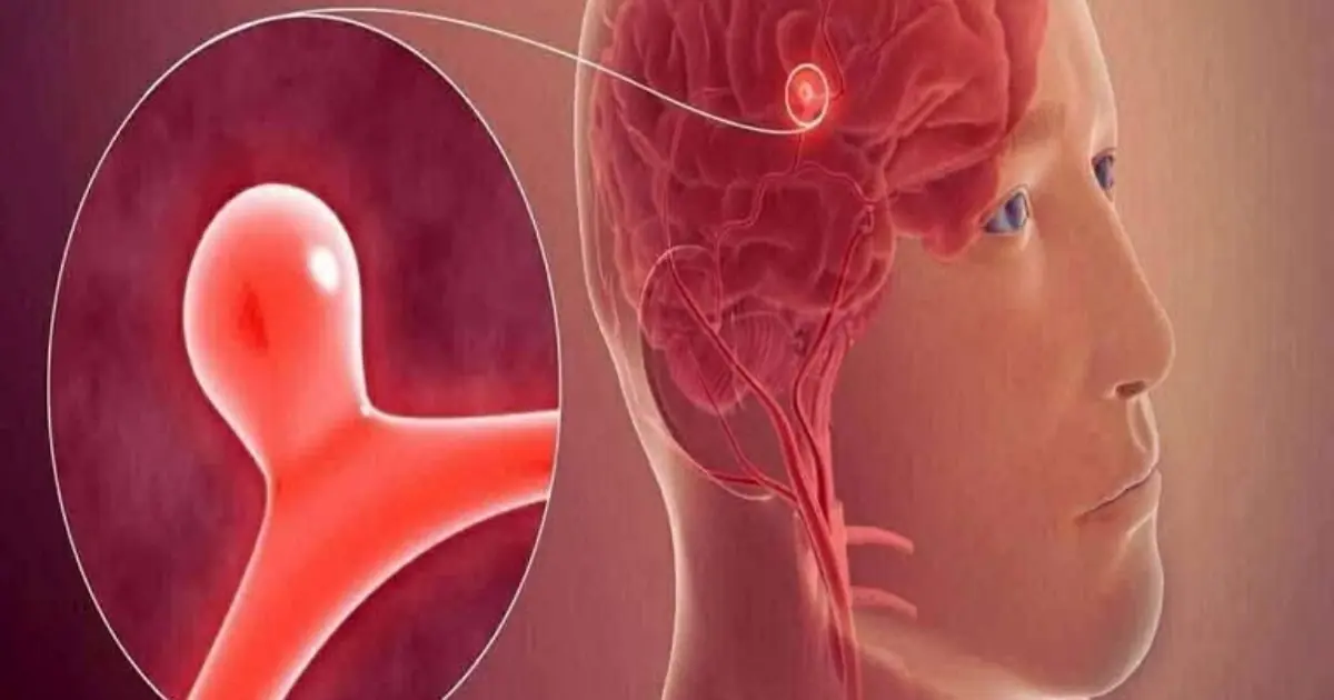 12 Warning Signs That May Signal a Brain Aneurysm — Don’t Ignore Them