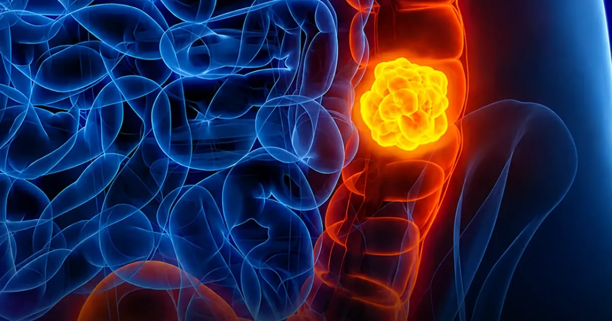 Woman Shares Five Colon Can.cer Symptoms She Initially Ignored