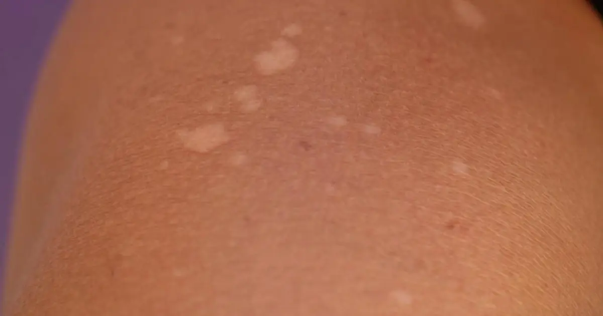 What Do Small White Spots on Your Arms or Legs Mean?