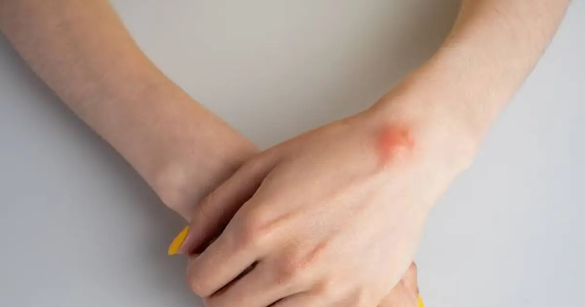 A Lump on Your Hand Isn’t Always What You Think — Here Are Some Possible Causes