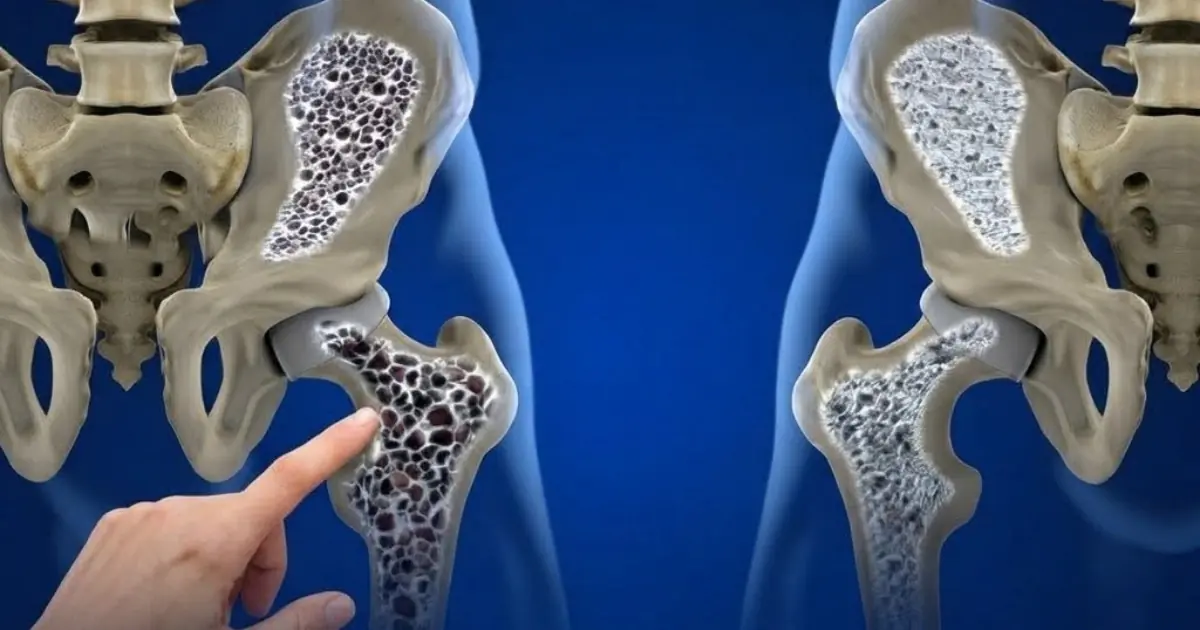 Concerned About Bone Health? 3 Drinks to Watch...