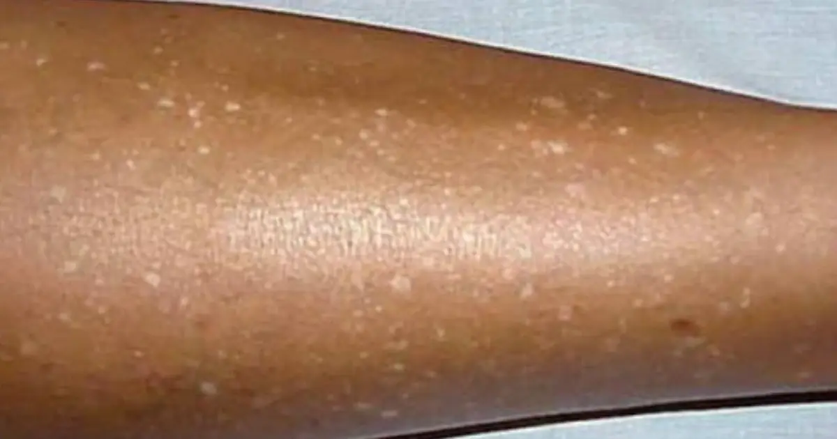 Do You Have Small White Spots on Your Arms or Legs? Here’s Why They May Appear