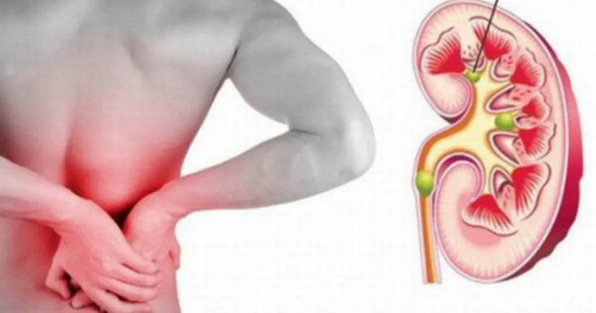 Kidney Health: 23 Early Signs You Shouldn’t Ignore