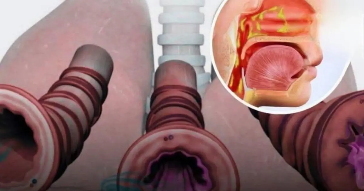 Struggling With Phlegm? Here’s How to Clear Your Chest and Throat