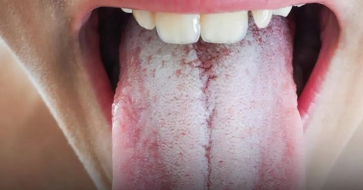 A White Tongue Could Be a Sign of an Underlying Health Issue — Here’s What Doctors Say
