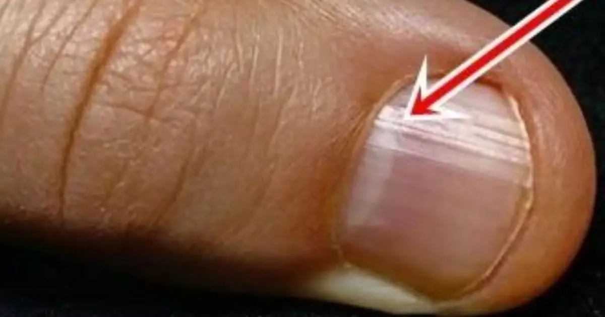 Your Nails Could Be Sending Warning Signs — Especially After 40