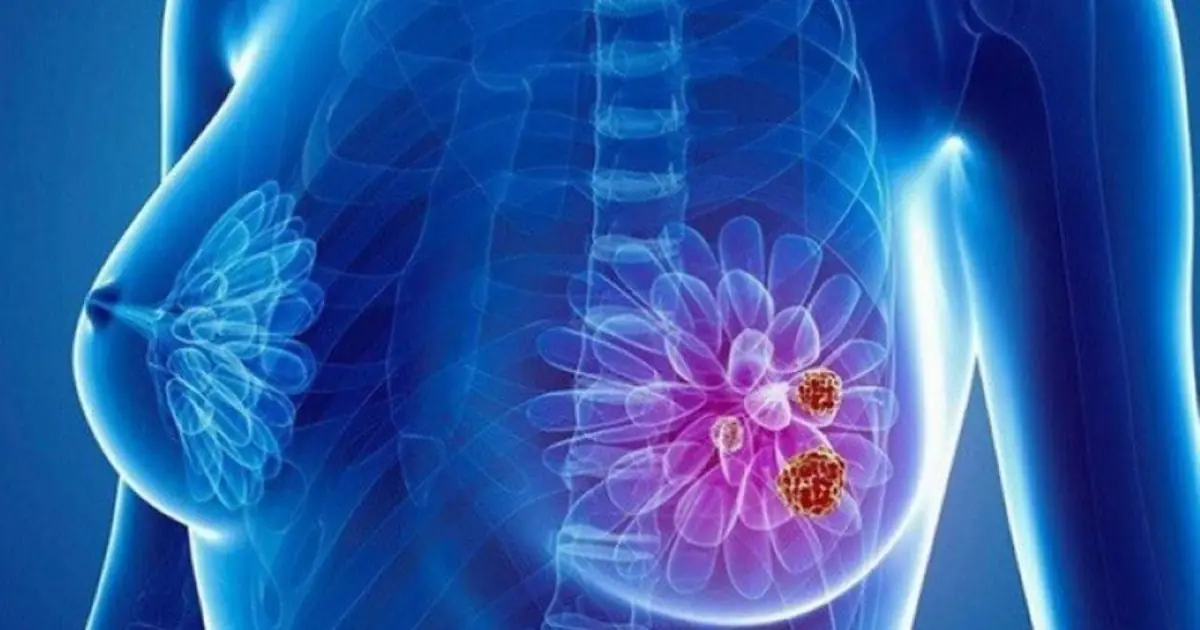 Your Body May Be Sending Signals: 8 Bre.ast Can.cer Warning Signs