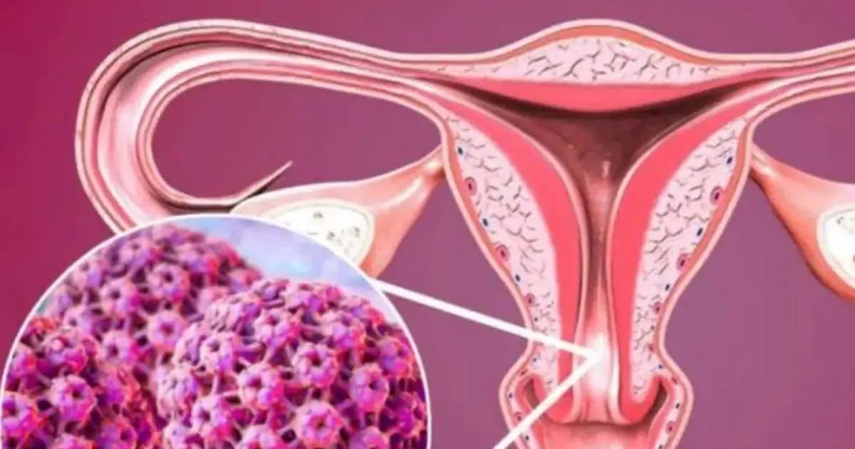 Cervical can.cer often develops silently and is usually detected too late. Don’t ignore these 5 early warning signs