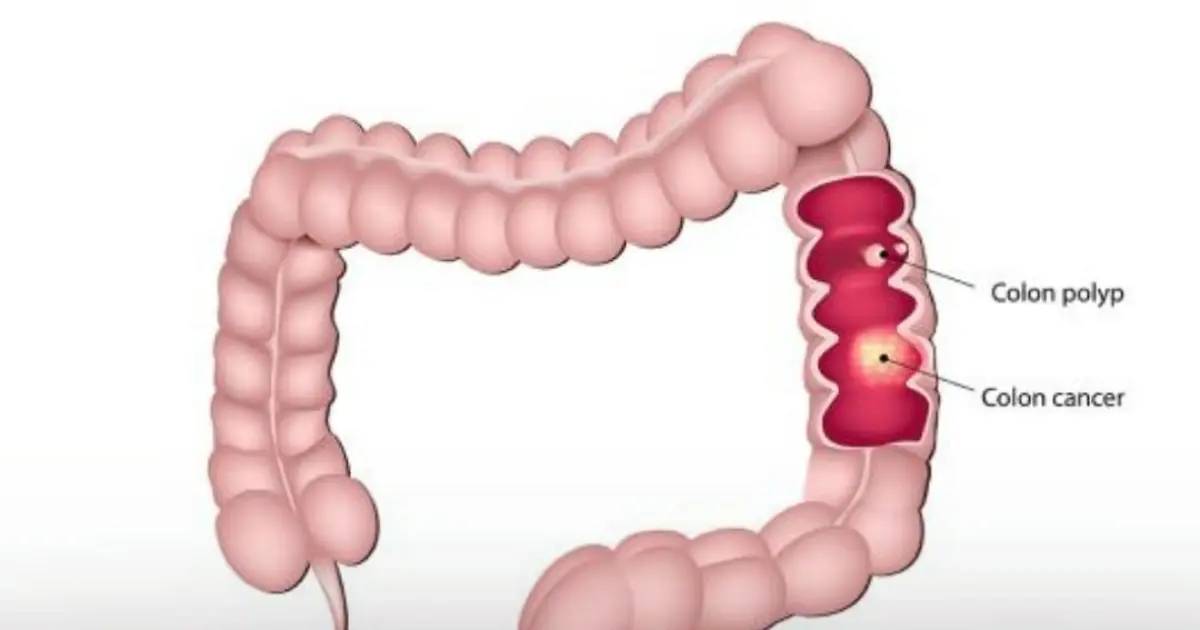 5 Important Warning Signs of Colorectal Cancer You Should Know