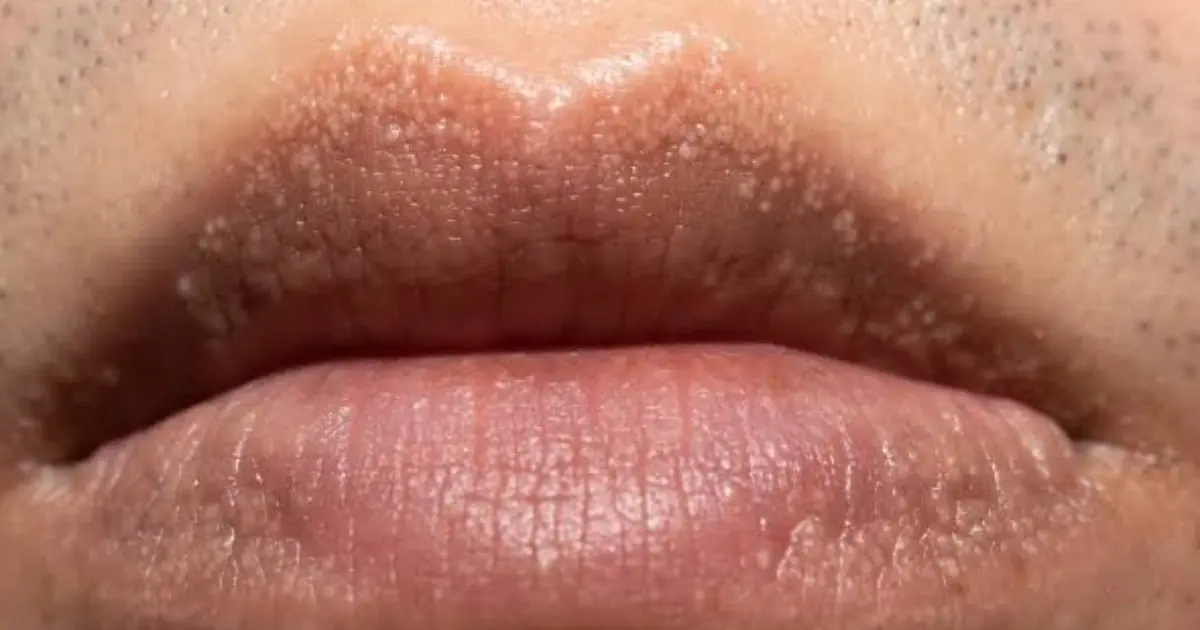 White Spots on the Lips or Ge.nital Area? Here’s What Your Body Could Be Telling You