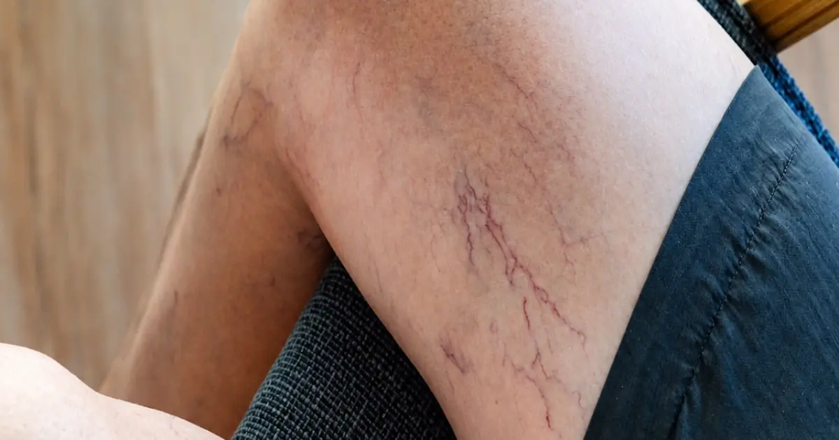 If you have purple veins on your legs, it means you are…