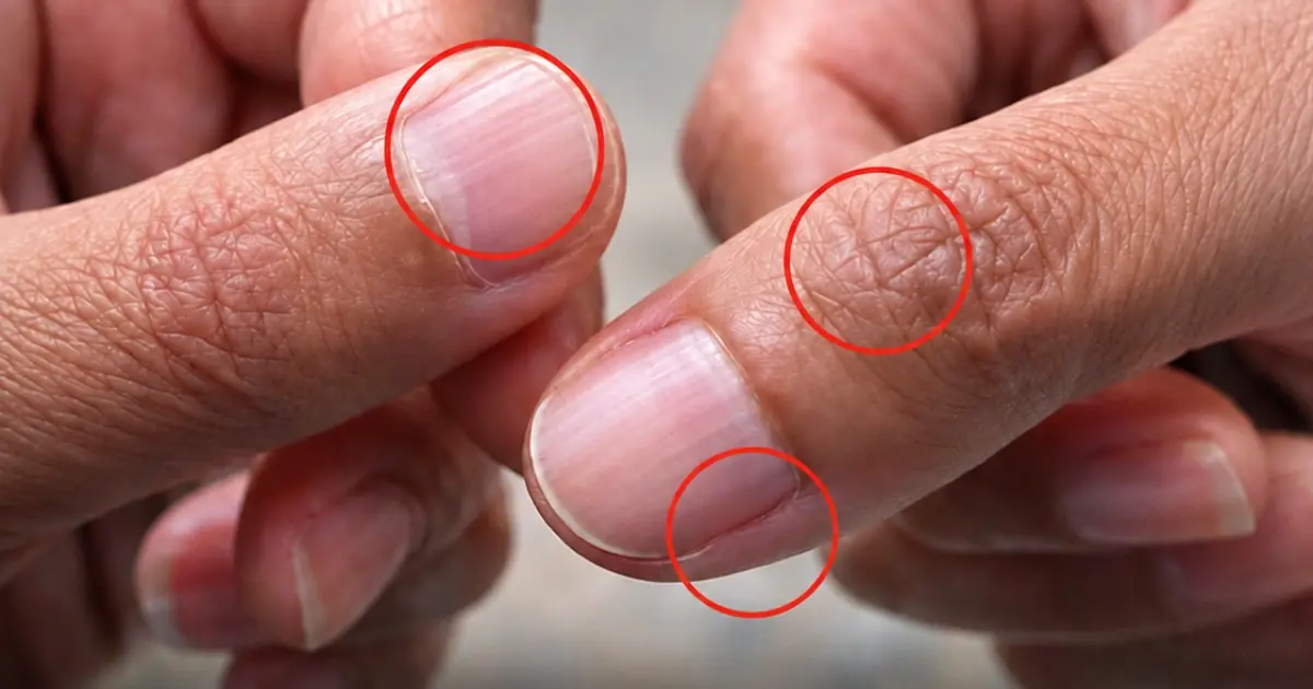 Having Striped Nails? Here’s What Your Body Might Be Trying to Tell You
