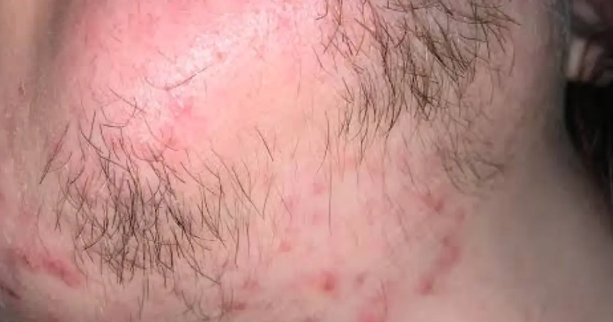 A Woman’s Chin Hair Could Be Telling You Something — Here’s What It May Mean
