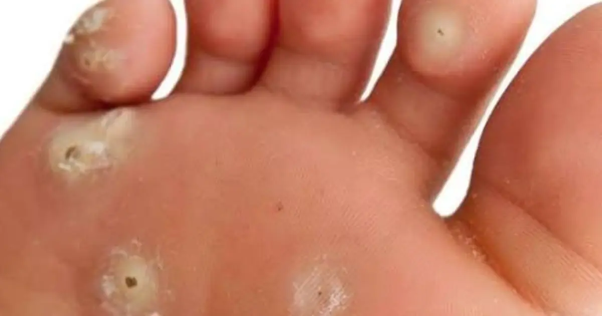 Those Rough Spots on Your Feet Might Be Plantar Warts…  Here’s What You Can Try at Home to Help Treat Them